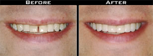 Dental Crown before and after