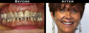 Dental Crown Before/After Photo