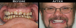Dental Crown Before/After Photo
