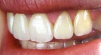 Dental Crowns and Bridges offer a Natural-Looking Smile