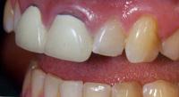 Dental Crowns and Bridges offer a Natural-Looking Smile